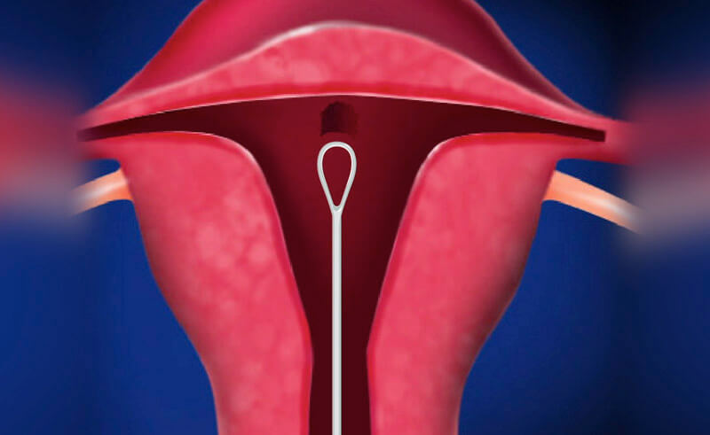 Dilation and Curettage1