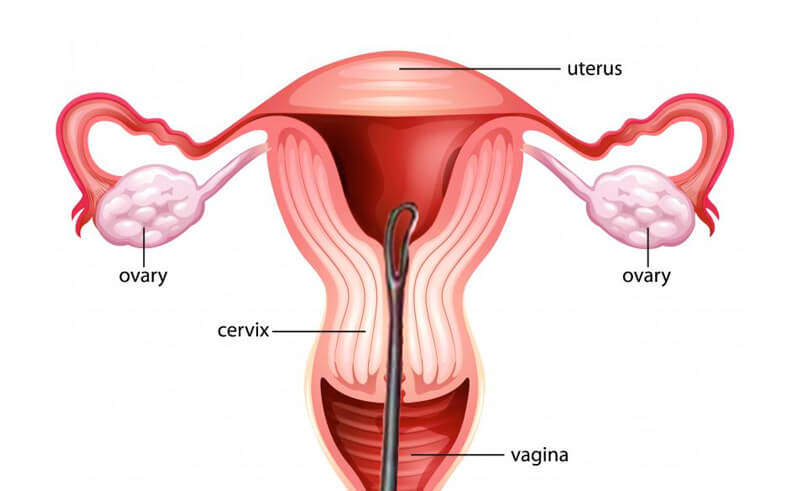 Dilation and Curettage2