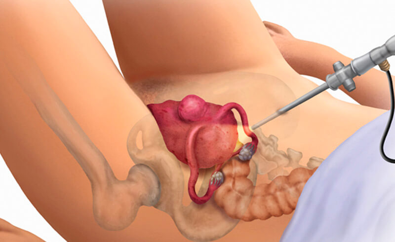 Dilation and Curettage3