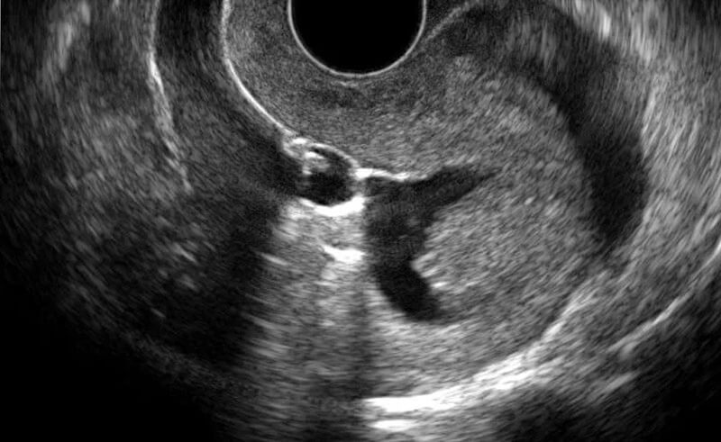 Sonohystogram Procedure